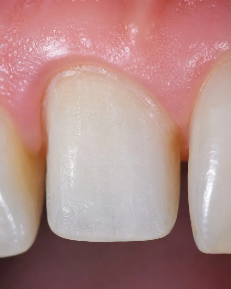 Préparation de facette et limite cervicale