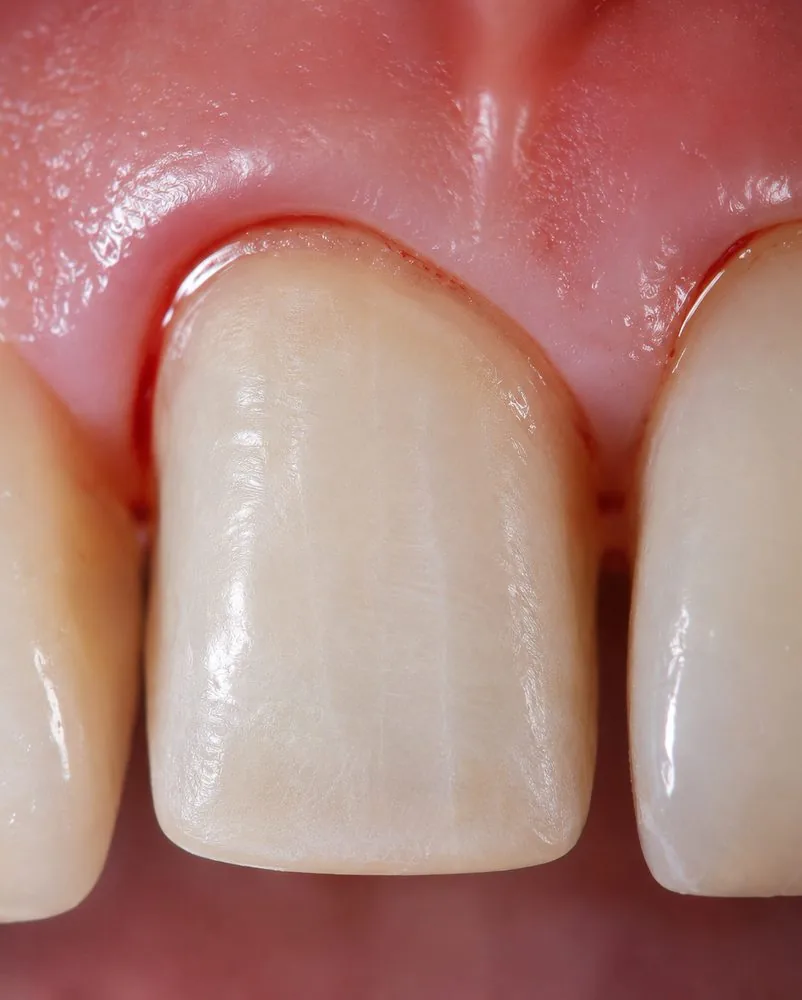 Sulcus humide, sang marginal