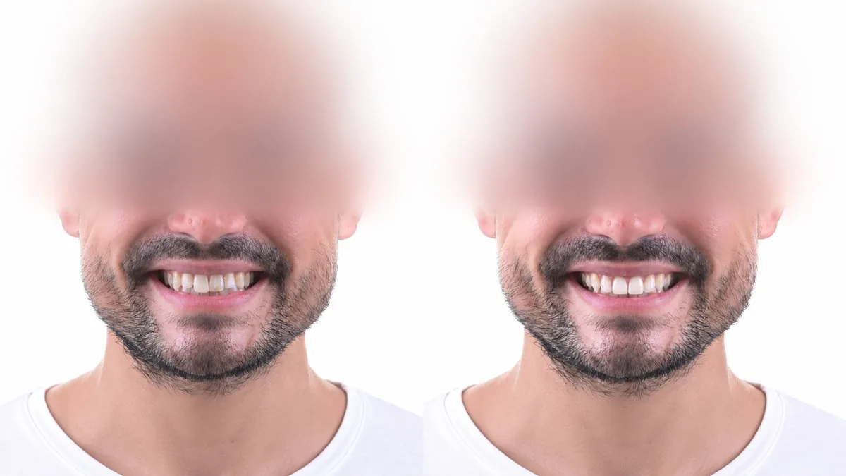 Before and after comparison, Smile Design analysis