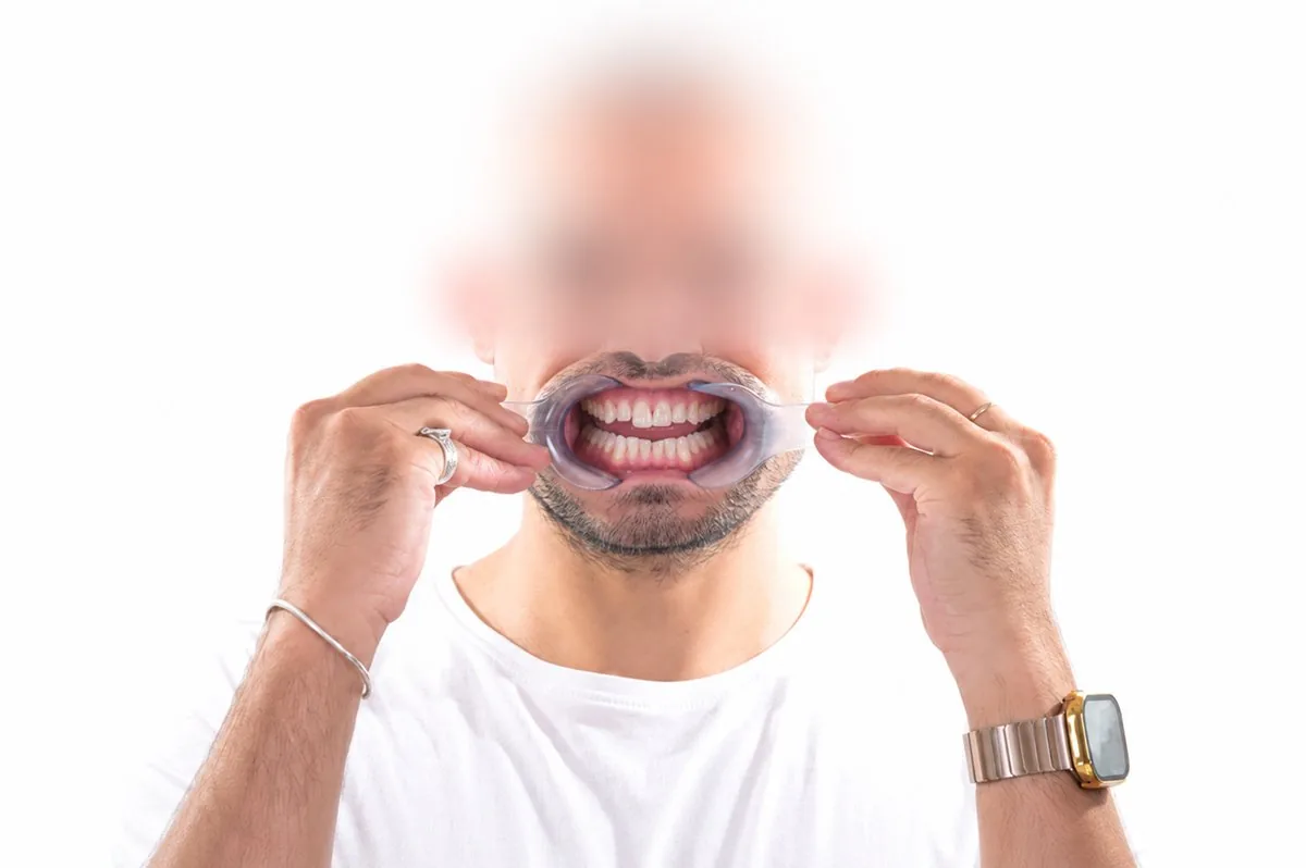 Smile with cheek retractors