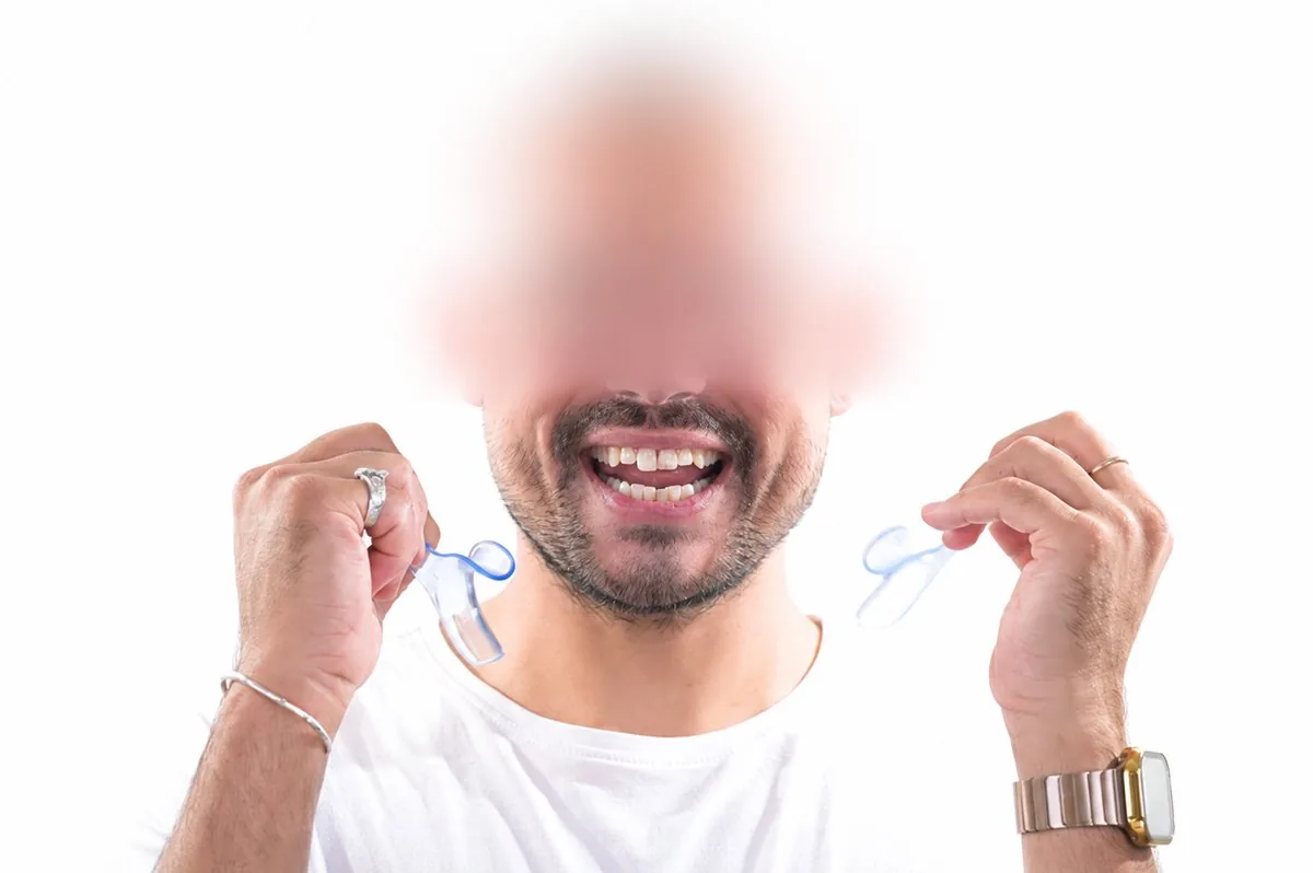 Smile without retractors